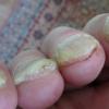 Почему утолщается ногтевая пластина большого пальца ноги