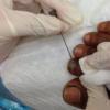 Как лечить синяки под ногтями больших пальцев ног?