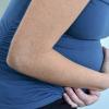 Ретрохориальная гематома при беременности: причины и лечение Осложнения и последствия